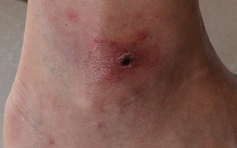 Biliary fever